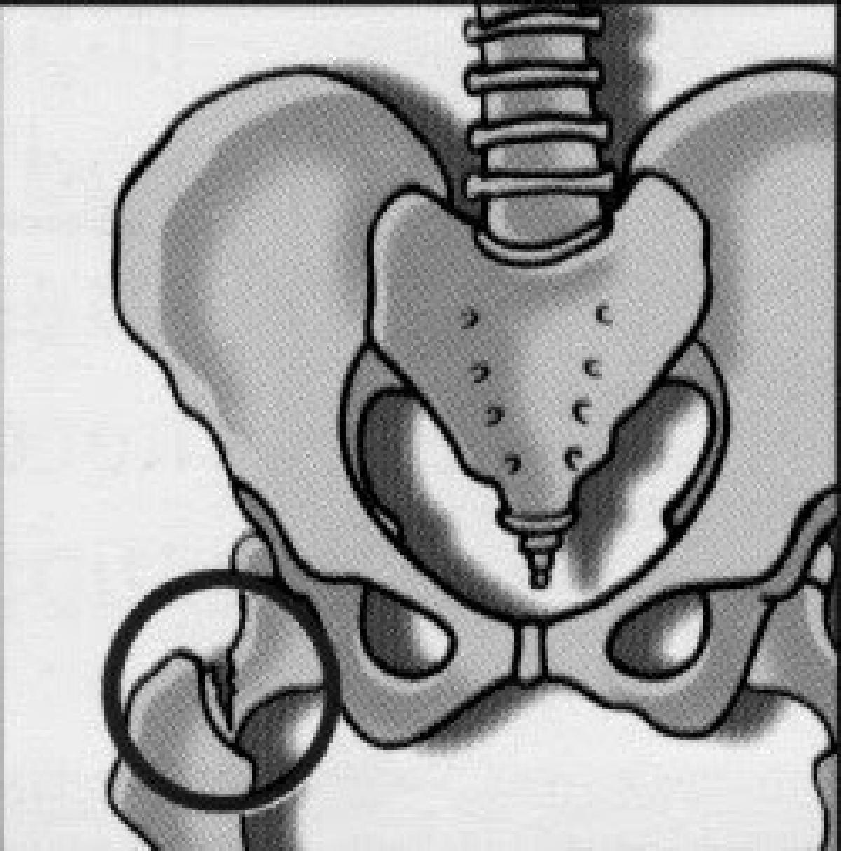 Τι είναι η οστεοπόρωση - Κάταγμα ισχίου, σπονδυλικής στήλης, καρπού