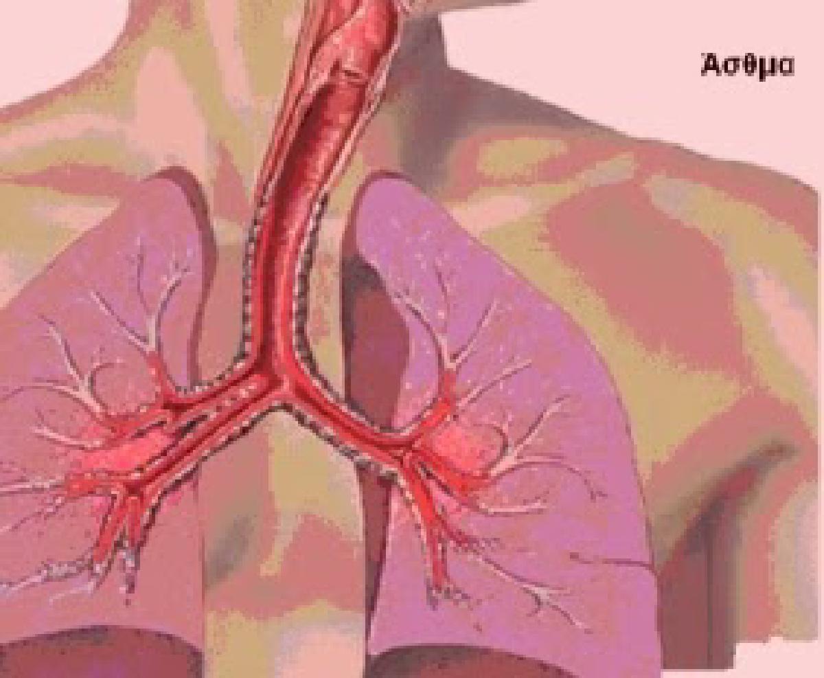 Τι είναι το άσθμα
